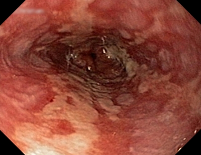 Image result for erosive esophagitis
